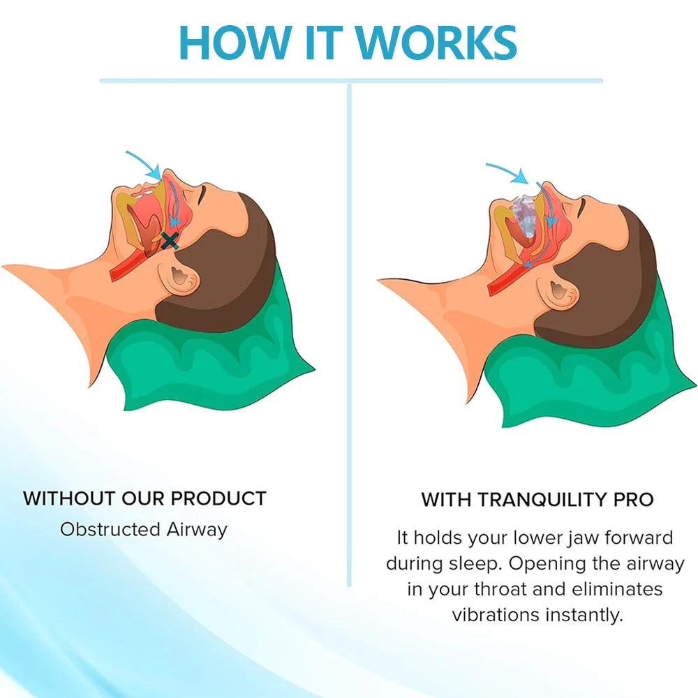 BackWell Anti-Snoring Mouth Guard